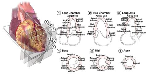 lv wall motion abnormality|left ventricular wall segments echo.